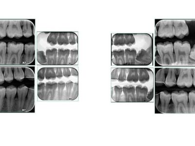 رادیوگرافی داخل دهانی 